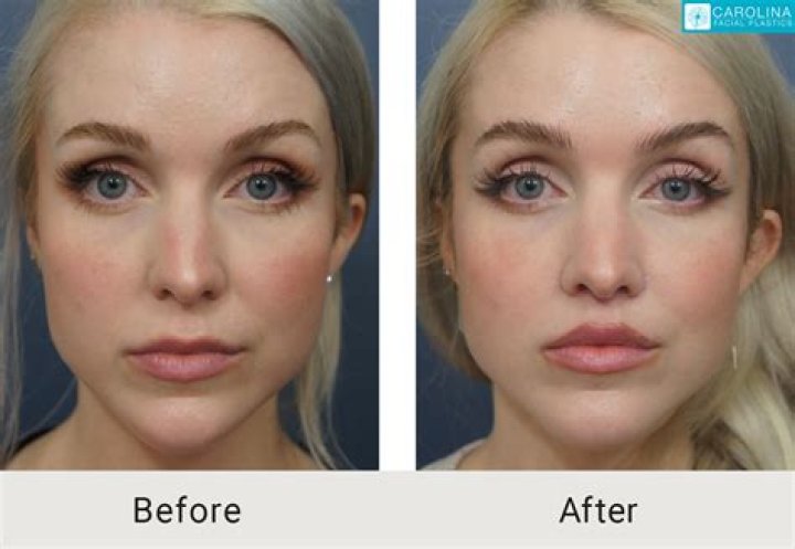 Nose Job, Facelift, Lip Augmentation & More!